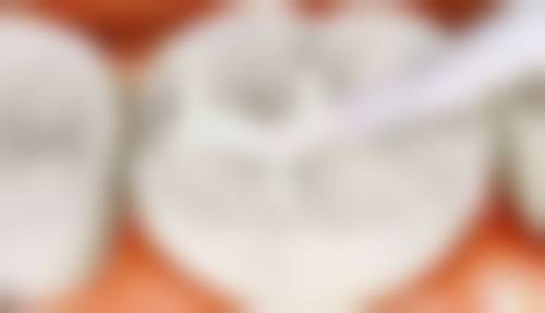 乌鲁木齐牙博士口腔树脂补牙好不好？蛀牙疼痛困扰终结，树脂补牙来救急啦 