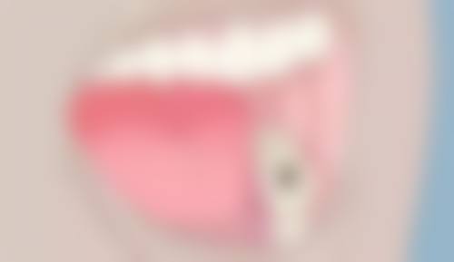 牙博士树脂补牙多少钱？医生耐心解疑惑