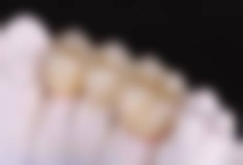 全口种植牙使用寿命是多久？受技术、品牌、护理等因素影响，或达数十年甚至终身