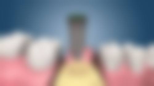 韩国登腾品牌种植牙质量怎么样？中高端水平、性价比高且临床反馈佳值得考虑