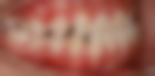 影响70岁老人做满口种植牙的因素