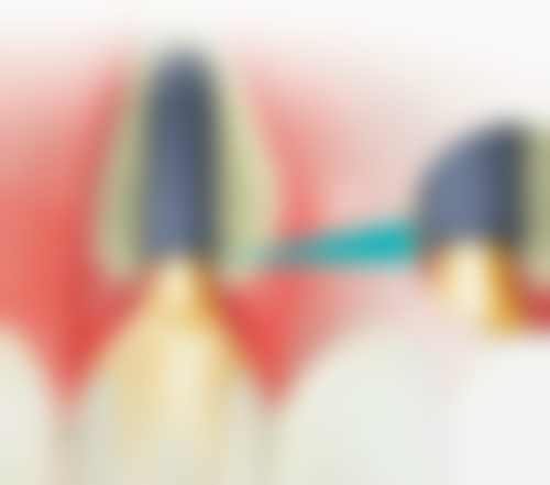 适用人群上，全瓷牙和种植牙什么区别