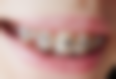 超声波洗牙治疗牙周炎的注意事项