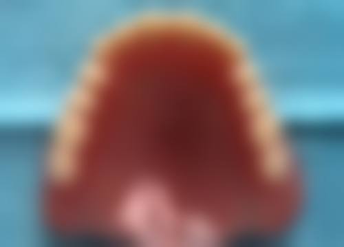 种植牙的适用人群和注意事项