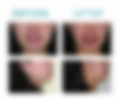 北京禾禾口腔门诊部科普：隐适美隐形矫正适合哪些人呢？