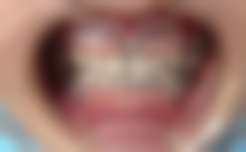 全口种植牙的不同方式有什么区别