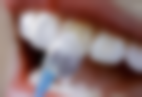 60岁老人种植牙的术前评估