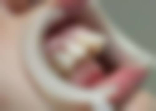 爱尔创全瓷牙和种植牙的联系