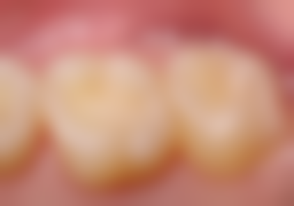 总结——沈阳铁岭昌图牙克拉口腔何龙凤医生怎么样？