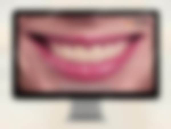 广州德伦口腔门诊部(东风总院)全瓷牙贴面项目适合哪些人?