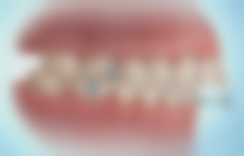 根管治疗的具体步骤