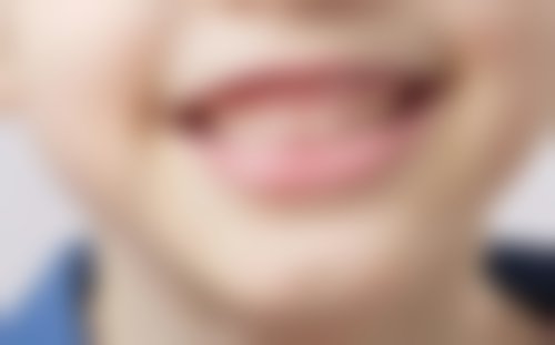 自己使用超声波洗牙器对牙齿的潜在危害