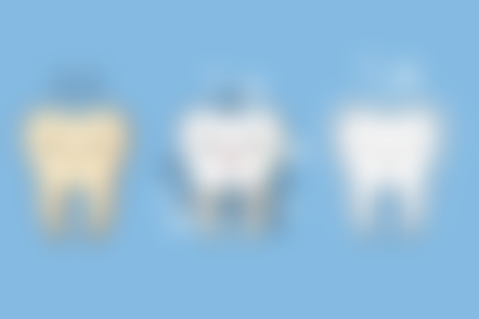 玻璃离子补牙和树脂补牙价格及综合对比