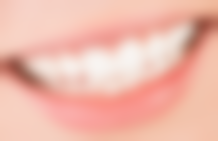 玻璃离子补牙和树脂补牙粘结性对比