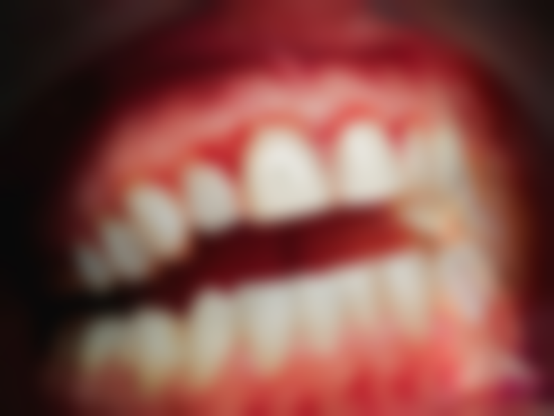 正畸拔牙和不拔牙有什么区别