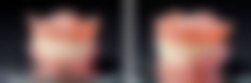 不同口腔卫生状况下的洗牙时间