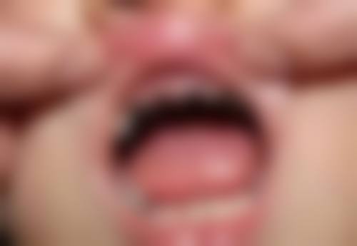 戴牙冠的好处