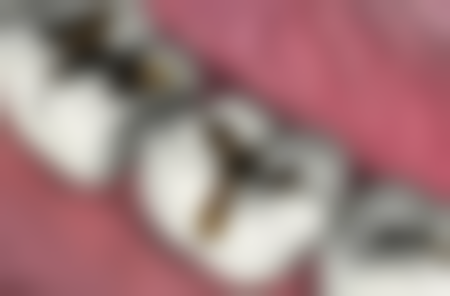 根管治疗中用于清理的灌洗材料