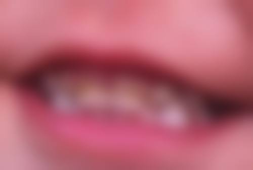烤瓷牙和全瓷牙颜色的稳定性有什么区别吗？