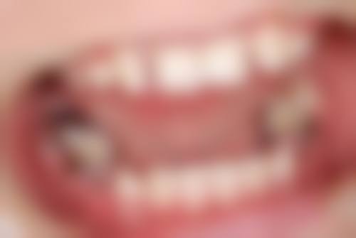 不同时间段拔牙洞的修复情况