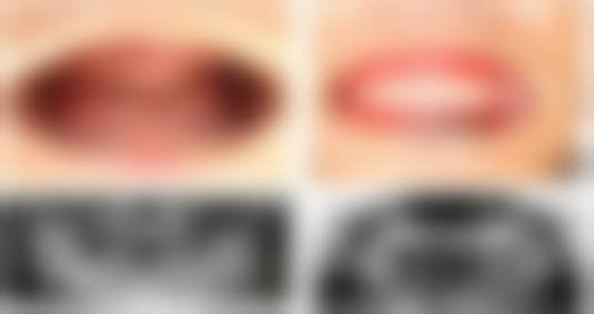 南京美奥口腔种植牙方案设计价格800元起吴凯医生技术好，当天出方案服务全助您重获好牙