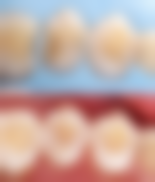 牙根坏了根管治疗有效吗？