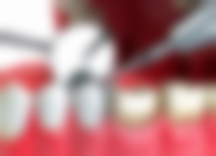 杀完神经补牙的价格和材料选择