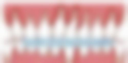 拔牙过程中需要注意什么