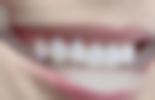 洗牙对有龋齿的儿童有啥好处